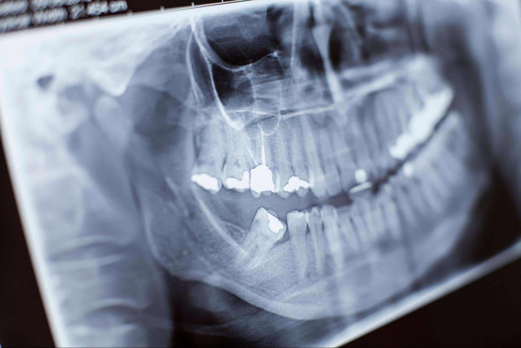 Sintomas De Muelas Del Juicio En Erupcion Somos Dental