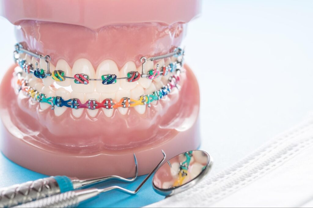 How-long-do-I-have-to-wear-dental-braces