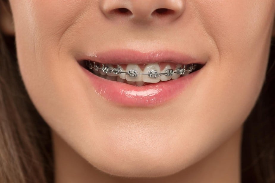 Can braces fix facial asymmetry? Somos Camelback Orthodontics