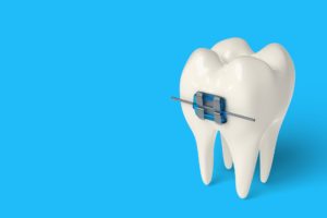 Learn about the different braces types that exist and choose the best one for you